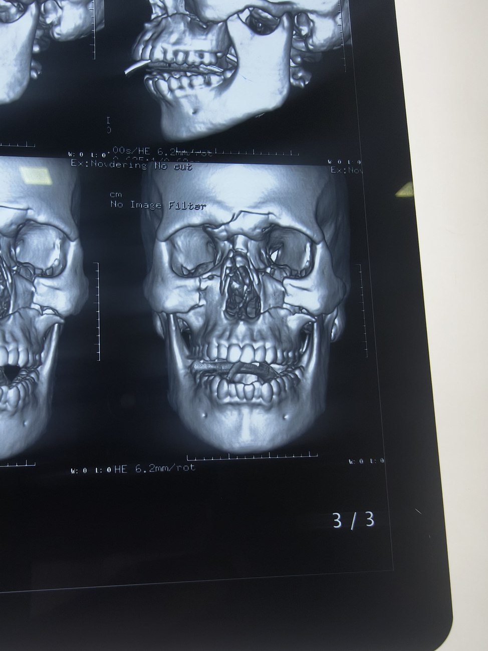 3D CT scan imaging used for diagnosis and planning