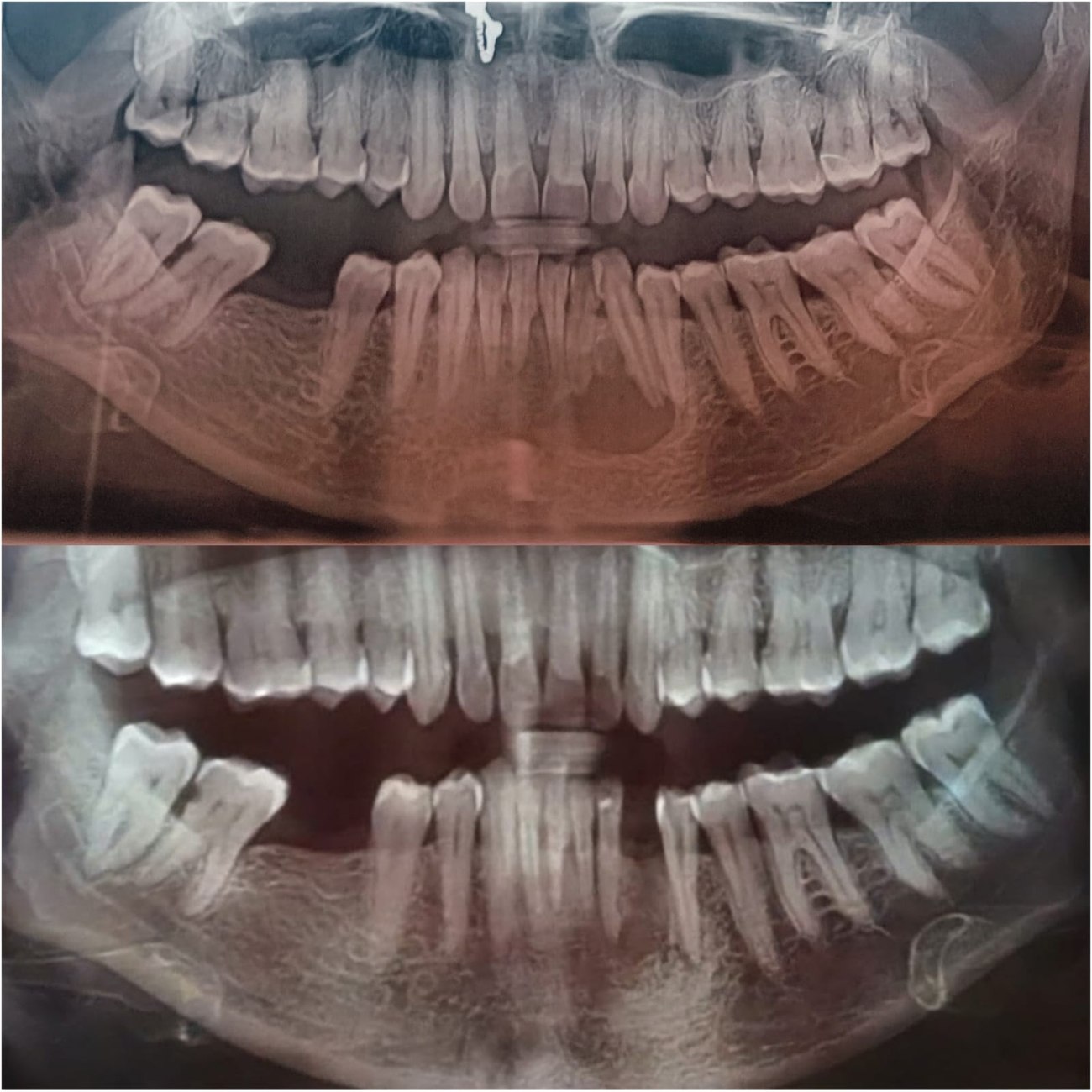 Panoramic dental X-rays