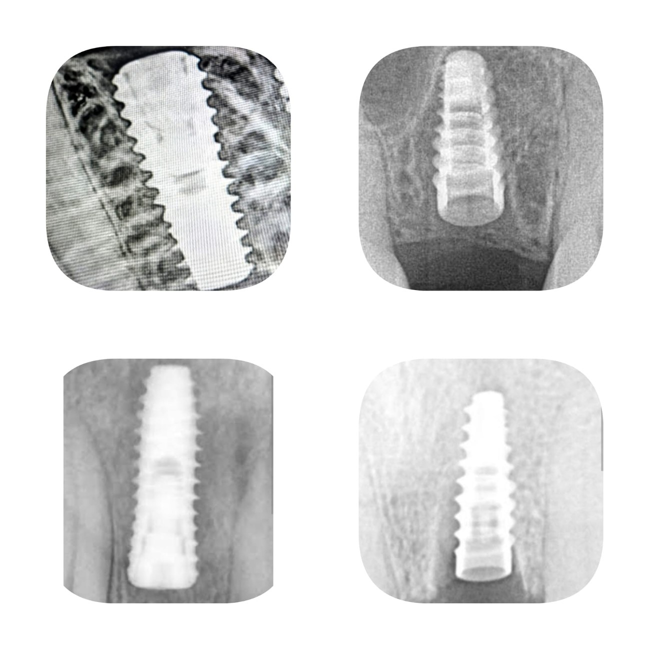 Dental implant X-ray imaging
