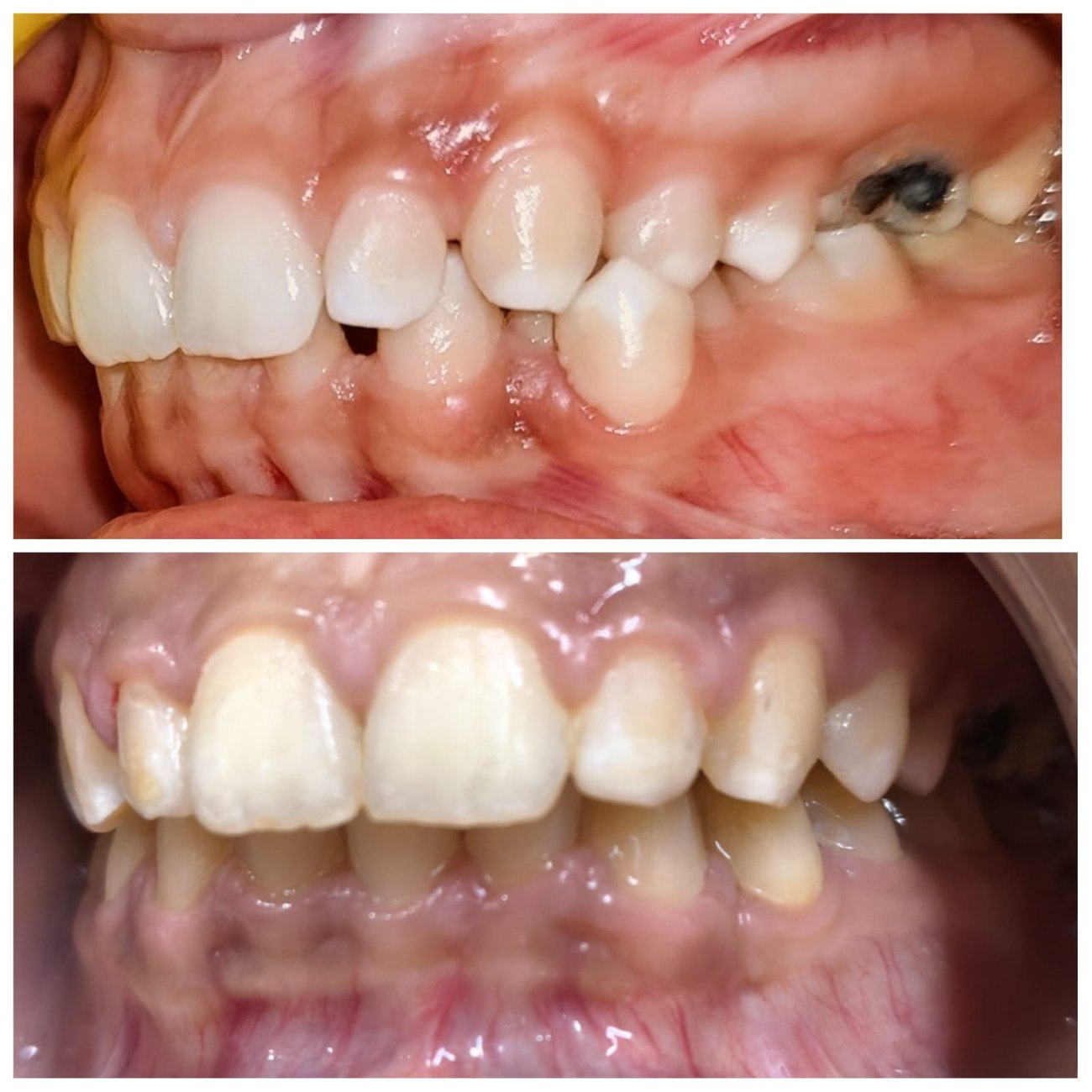 Patient smile before and after treatment