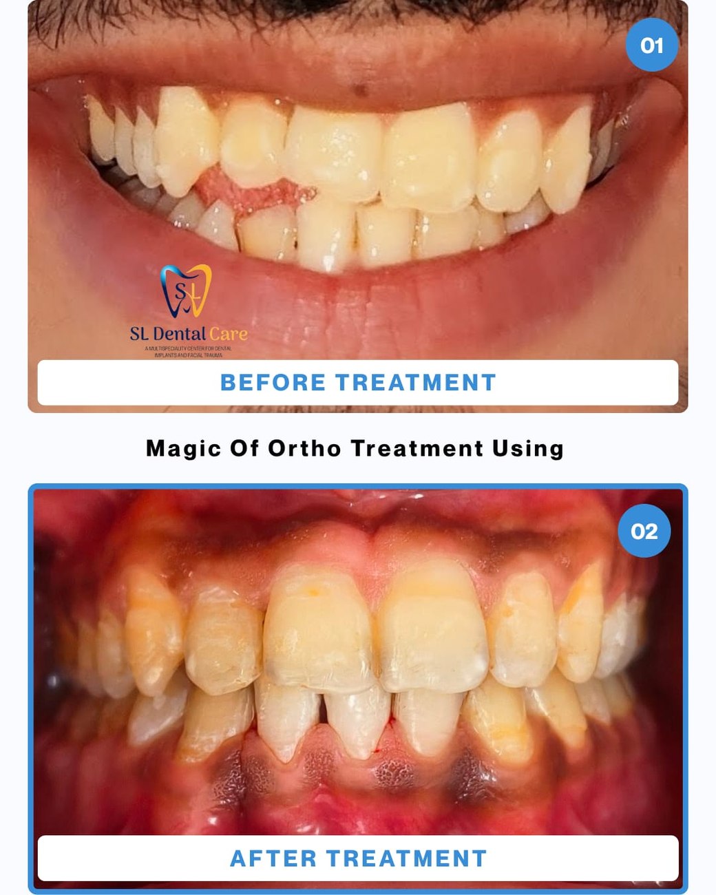 Patient smile before and after orthodontic treatment