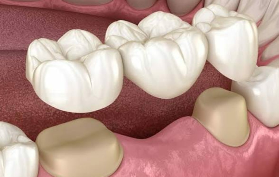 Dental crown and bridge restoration
