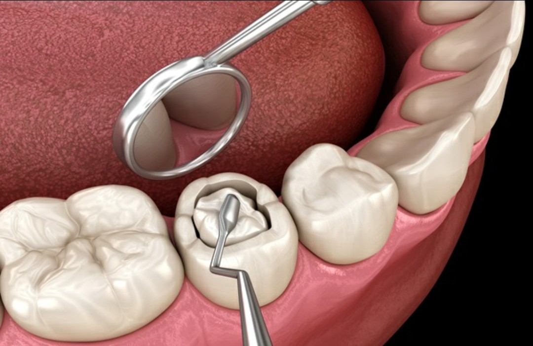 Tooth-colored composite filling procedure
