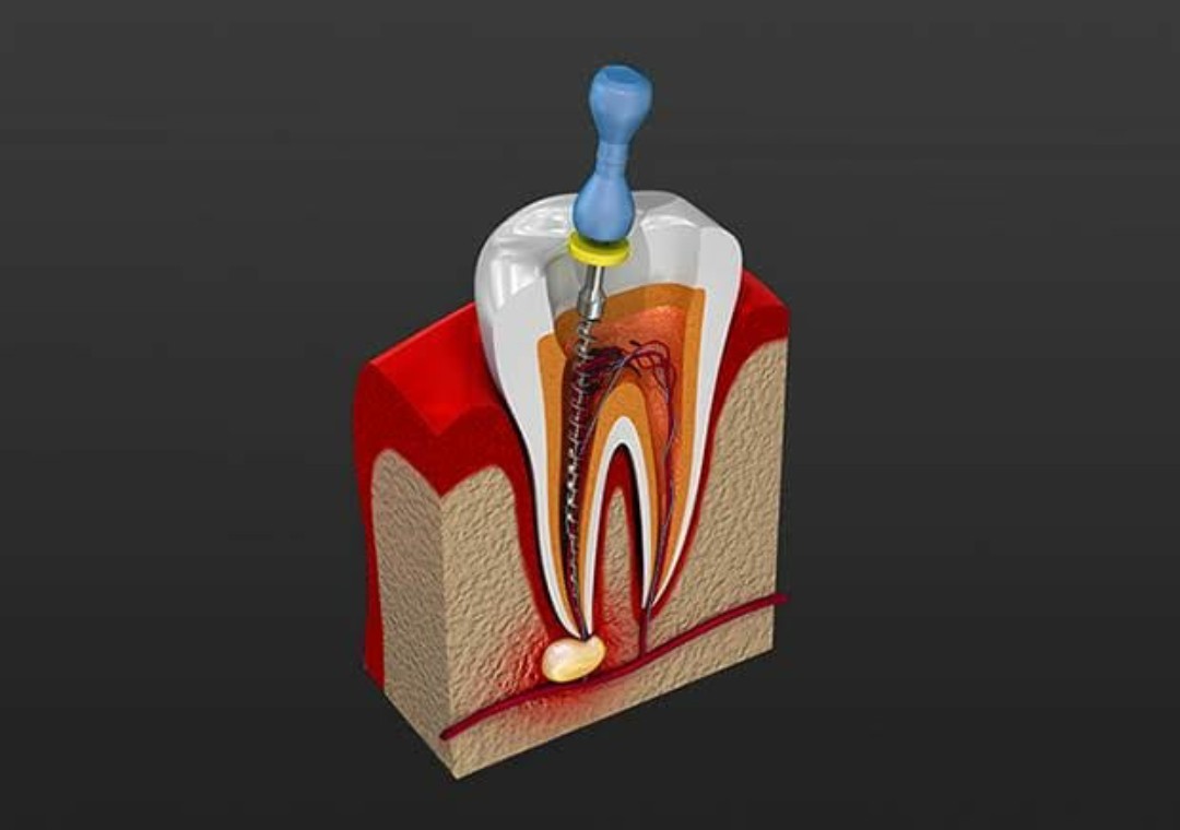 Root canal treatment cross-section illustration