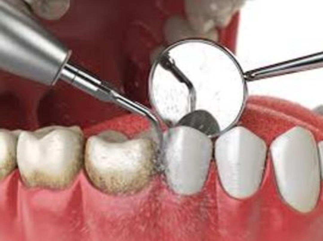 Scaling and polishing to remove plaque and tartar